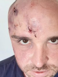 blessures FX