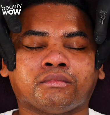Modèle visage homme acné
